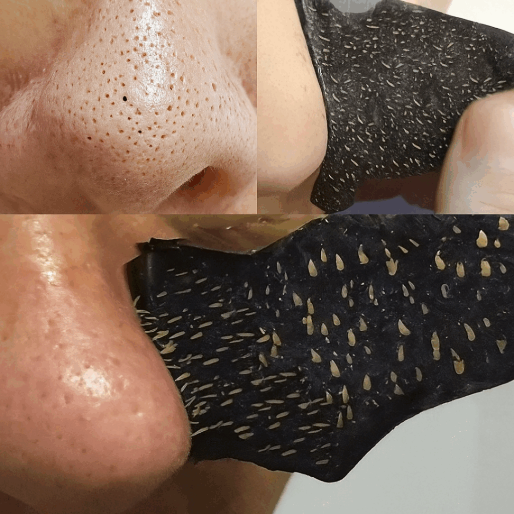 O QUE ESTÃO FALANDO SOBRE O NOSSO METODO DE REMOÇAO DE CRAVOS! (1)